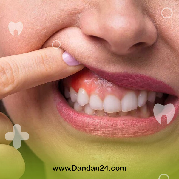 oral-cancer