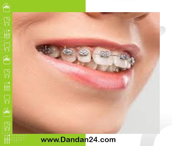ارتودنسی دندان در بزرگسالان: مزایا و معایب