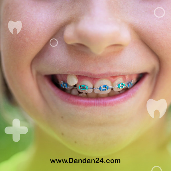 orthodontics-to-correct-missing-teeth3