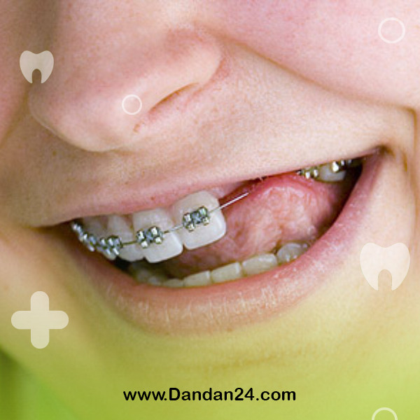 orthodontics-to-correct-missing-teeth
