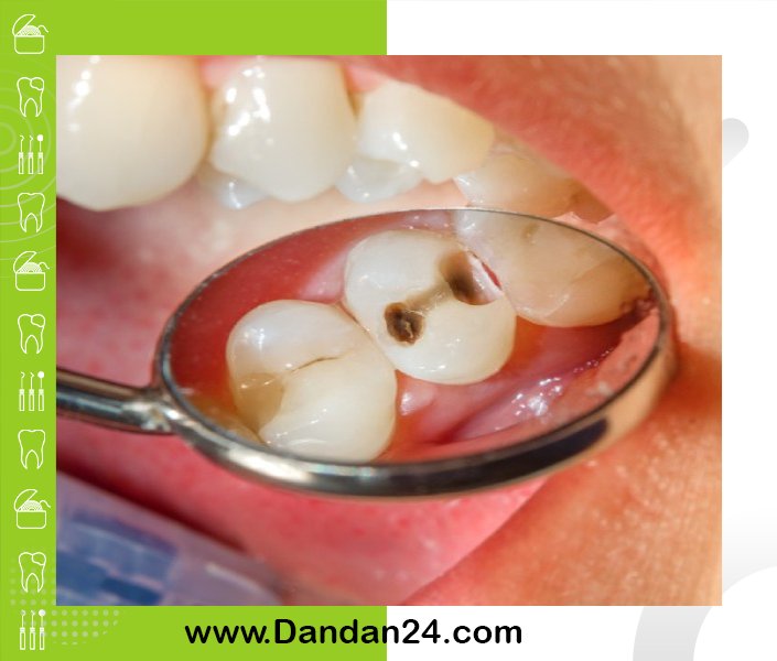 پیشگیری از پوسیدگی دندان با تغییرات ساده در رژیم غذایی