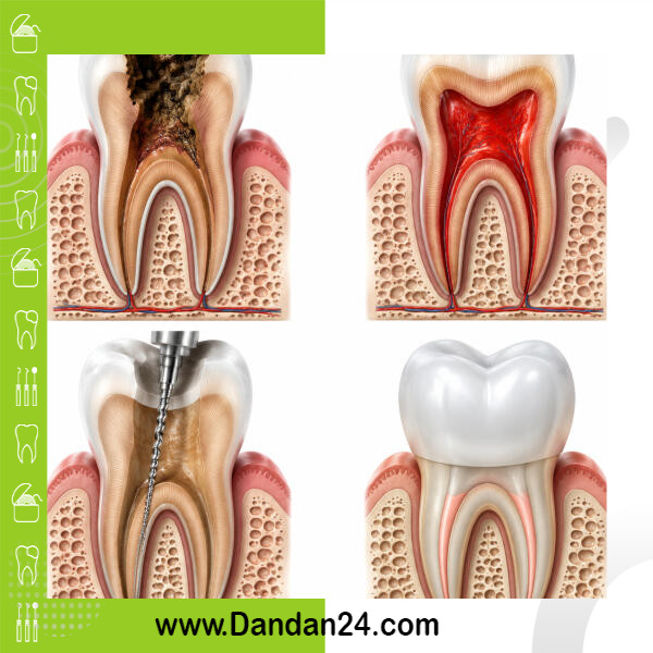 عصب کشی دندان چگونه انجام می شود و چه زمانی به آن نیاز دارید؟