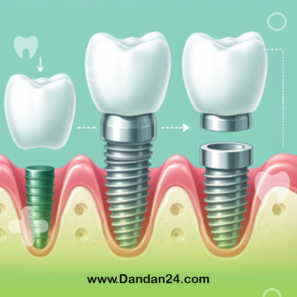 symptoms of dental implant failure