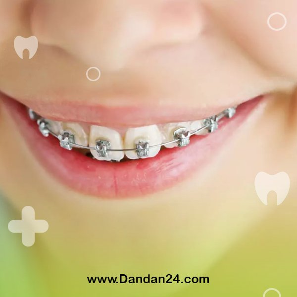 the-best-age-for-orthodontics