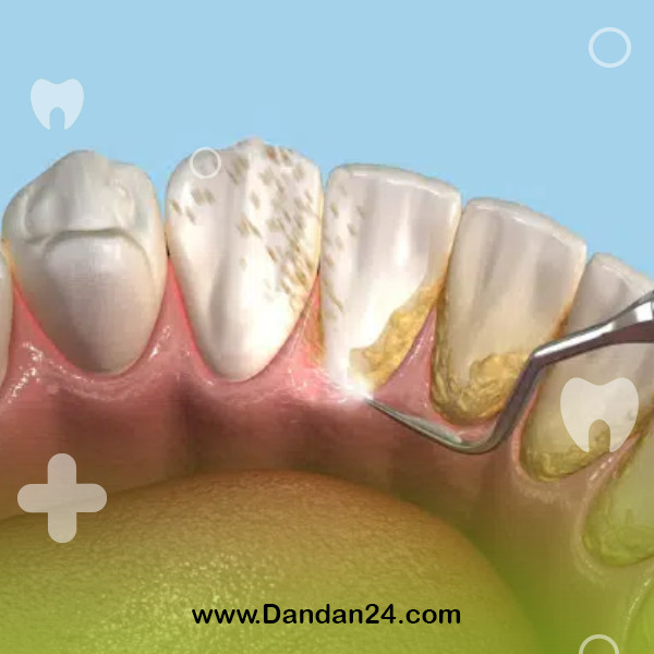 the-effect-of-dental-scaling-on-the-improvement-of-bad-breath2