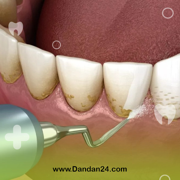 the-effect-of-dental-scaling-on-the-improvement-of-bad-breath