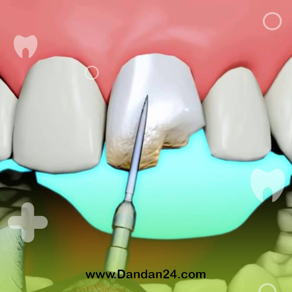 the-importance-of-specialized-endotherapy