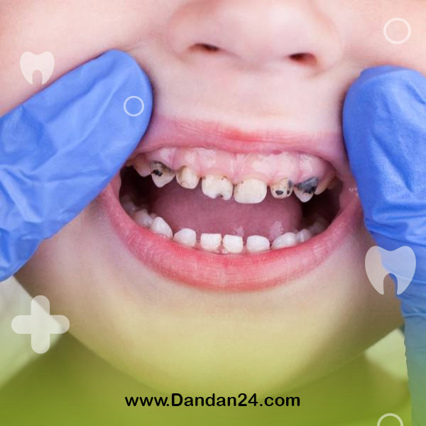 tooth-decay-in-children-causes-prevention-and-treatment2