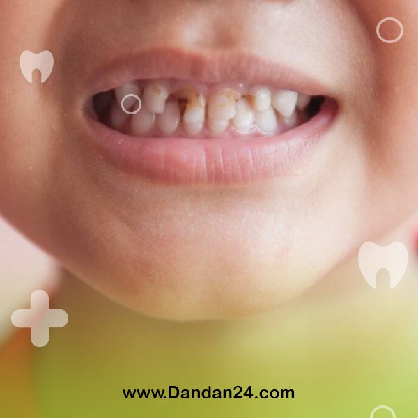 tooth-decay-in-children-causes-prevention-and-treatment