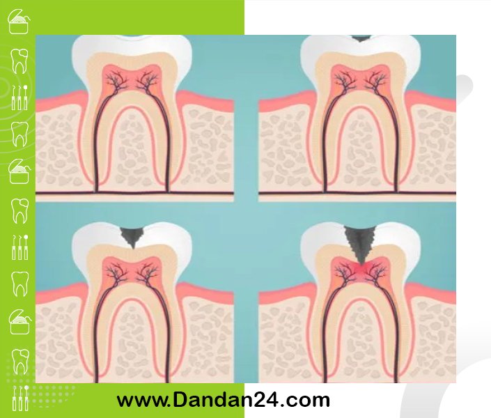 چرا مینای دندان در شب حساس  تر است؟ بررسی ریتم شبانه  روزی در سلامت دهان