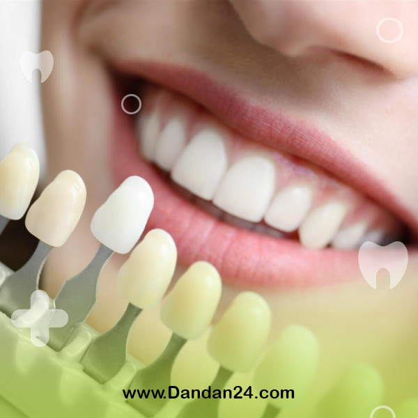 tooth-sensitivity-after-laminate