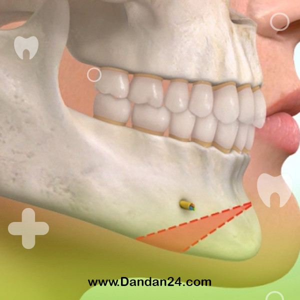treatment-of-backwardness-of-the-lower-jaw