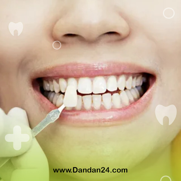 types-of-dental-veneers2