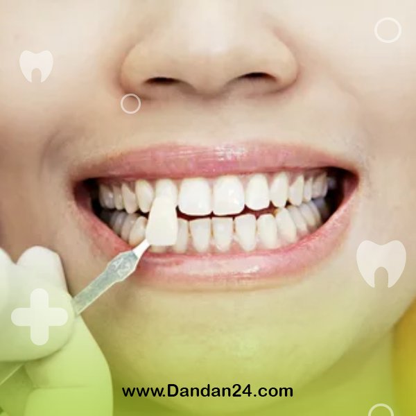 types-of-dental-veneers2