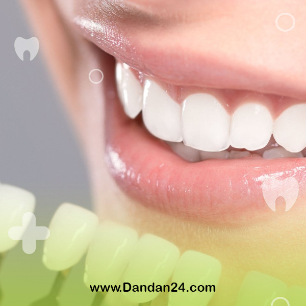 types-of-dental-veneers