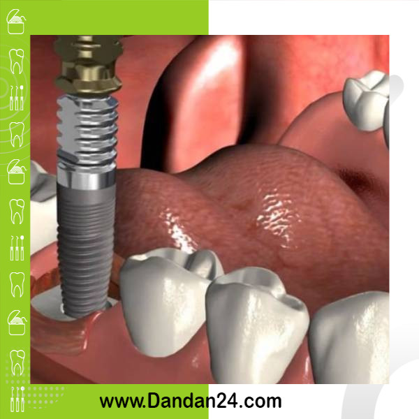 what-is-an-immediate-implant