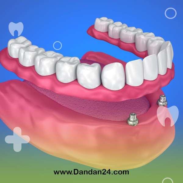 What is an overdenture?