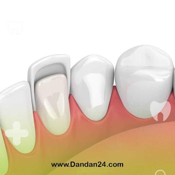 What is dental laminate?