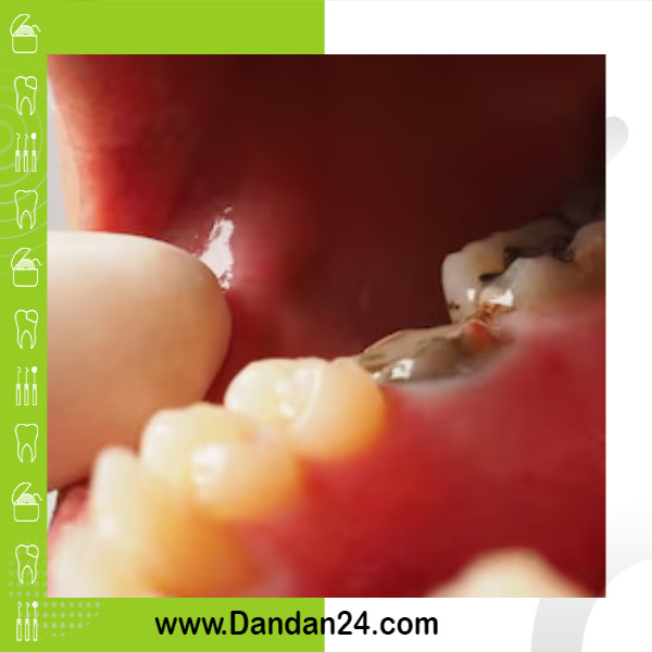 جرم دندان: چه چیزی است و چگونه از آن جلوگیری کنیم؟
