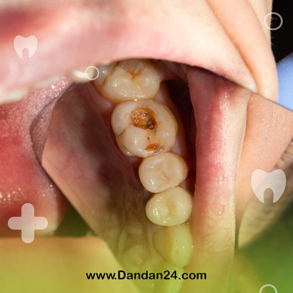 what-is-tooth-decay2