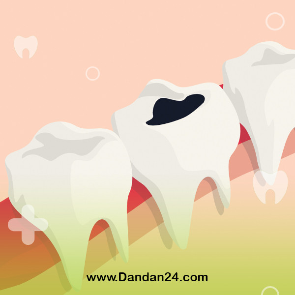 what-is-tooth-decay