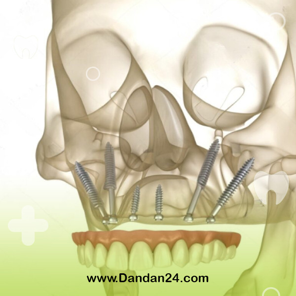 zygomatic-implant3