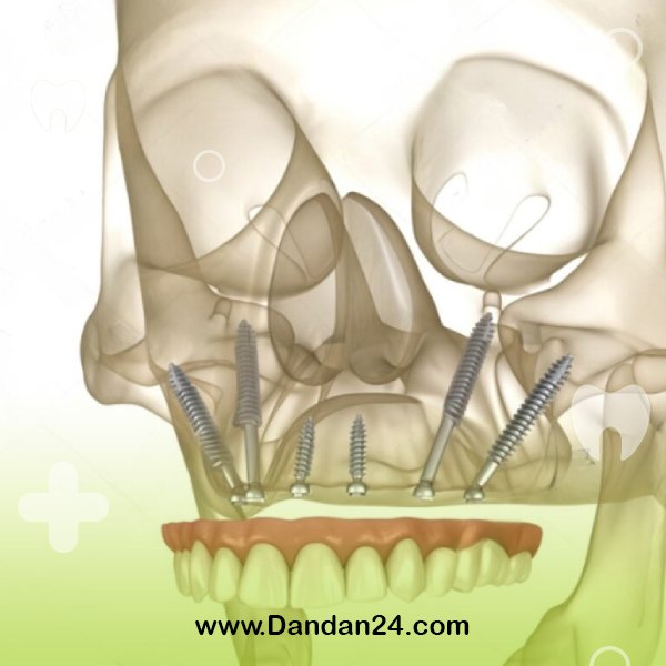 zygomatic-implant3