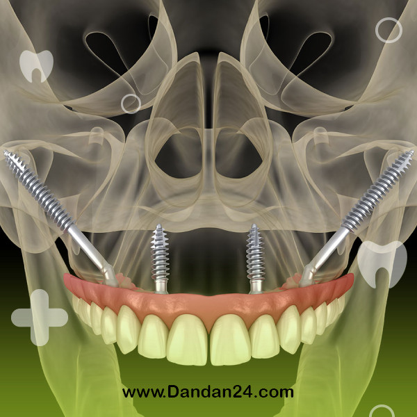 zygomatic-implant