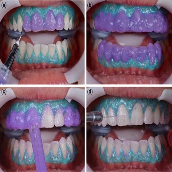 مراحل بلیچینگ در بهترین کلینیک و دندانپزشک بلیچینگ