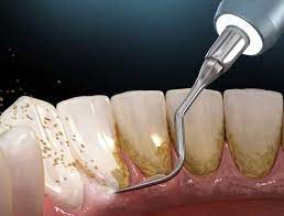 جرم گیری دندان در بهترین کلینیک